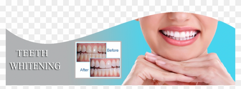 Call Us - Braces Fixed Canted Smile Clipart #4052076