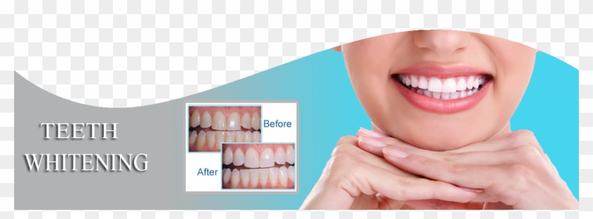 Call Us - Braces Fixed Canted Smile Clipart