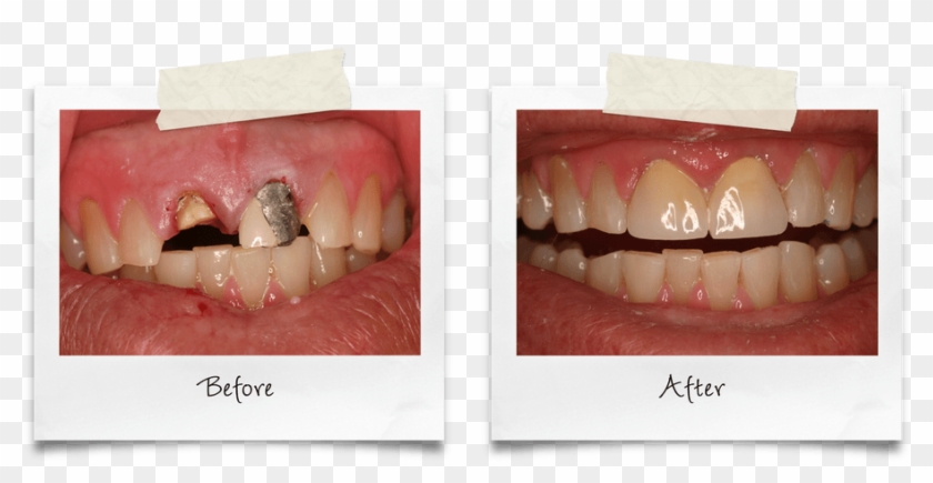 Replaced Broken Crown From A Car Accident - Composite Material Clipart #4075978