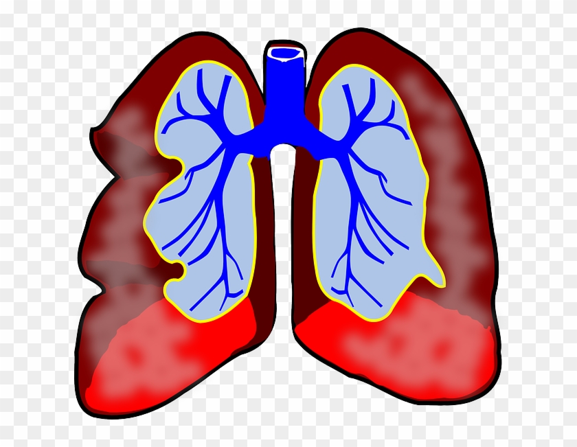 Boston Scientific Brings Next Generation Asthma Therapy - Lungs Clip Art - Png Download