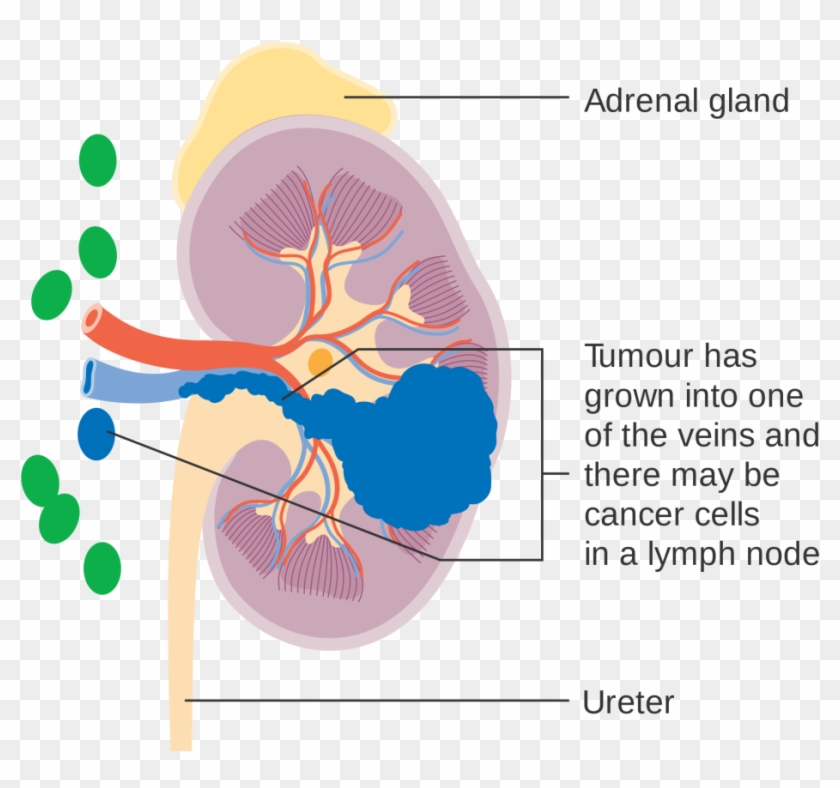 Kidney Cancer Surgery - Kidney Cancer Clipart #4240449
