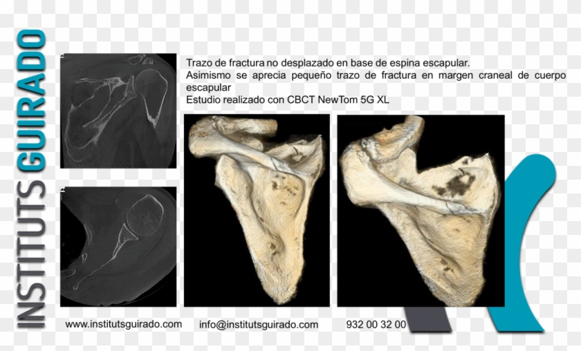 Instituts Guirado On Twitter - Bone Clipart