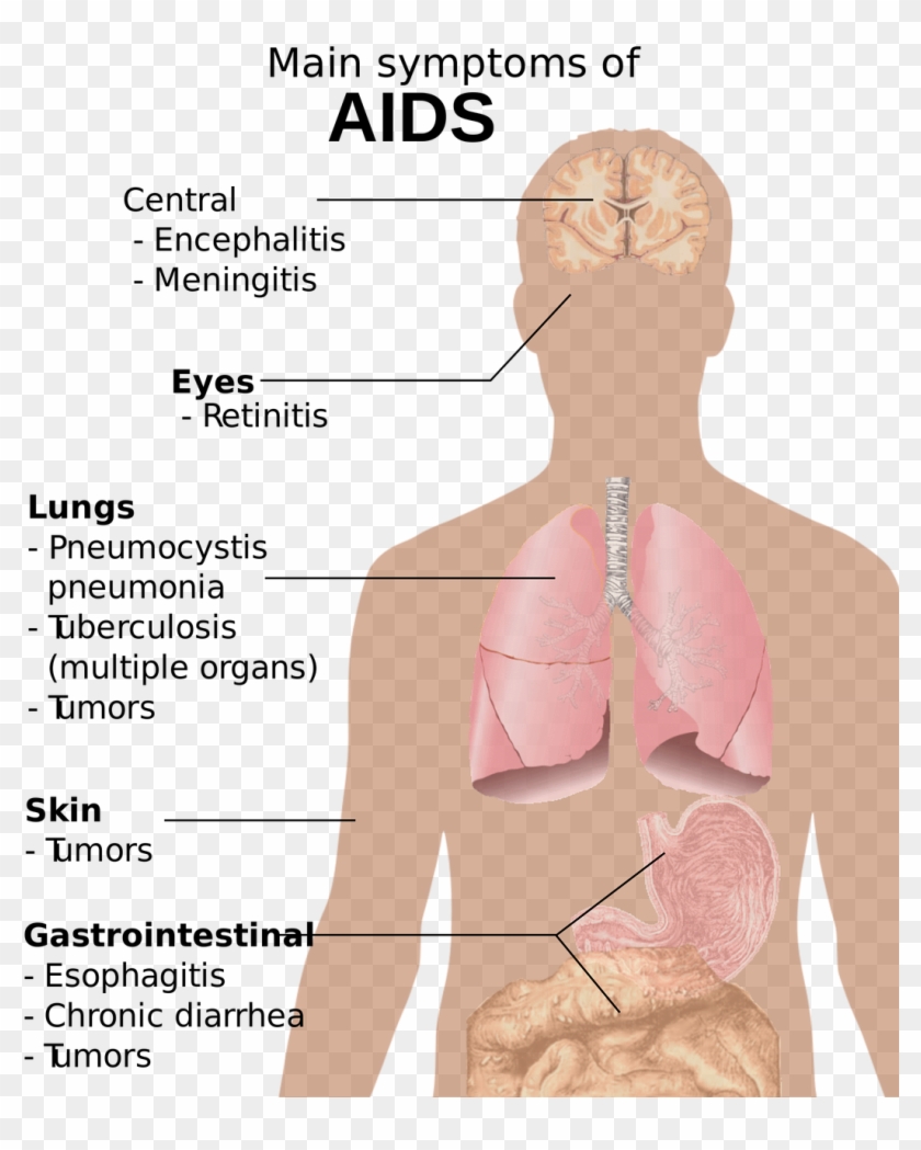 Hiv Aids Png 2-2 Png Image - Symptoms Of Aids Clipart #4274966