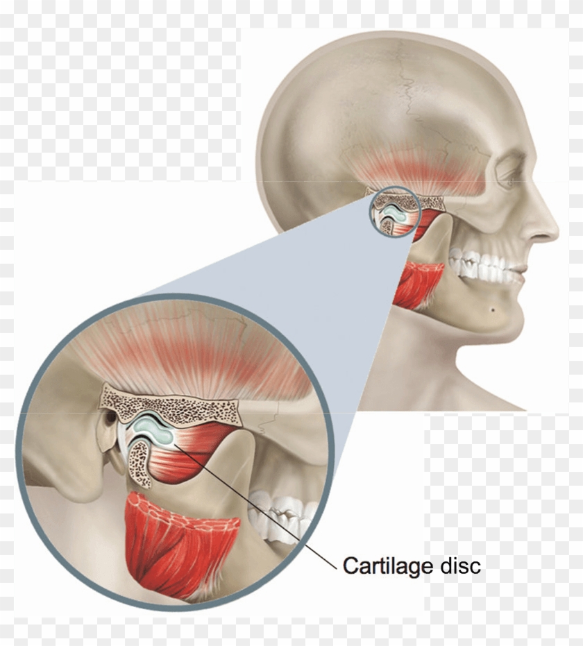 Illustration Showing The Temporomandibular Joint - Tmj Surgery Clipart