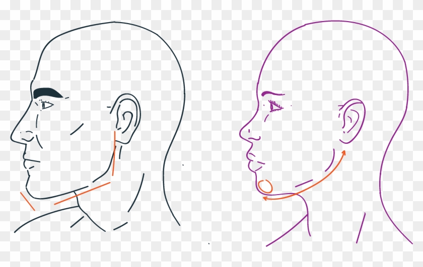 Jaw Reduction In Facial Feminization Surgery - Drawing Clipart