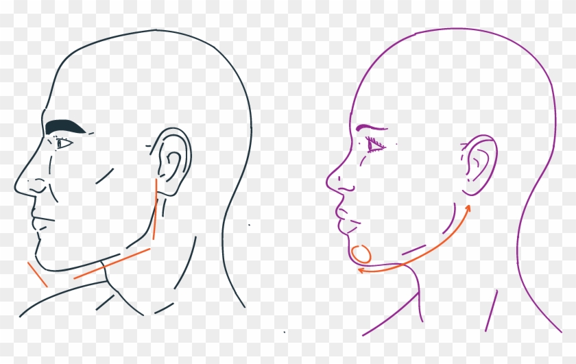 Jaw Reduction In Facial Feminization Surgery - Drawing Clipart #4281288