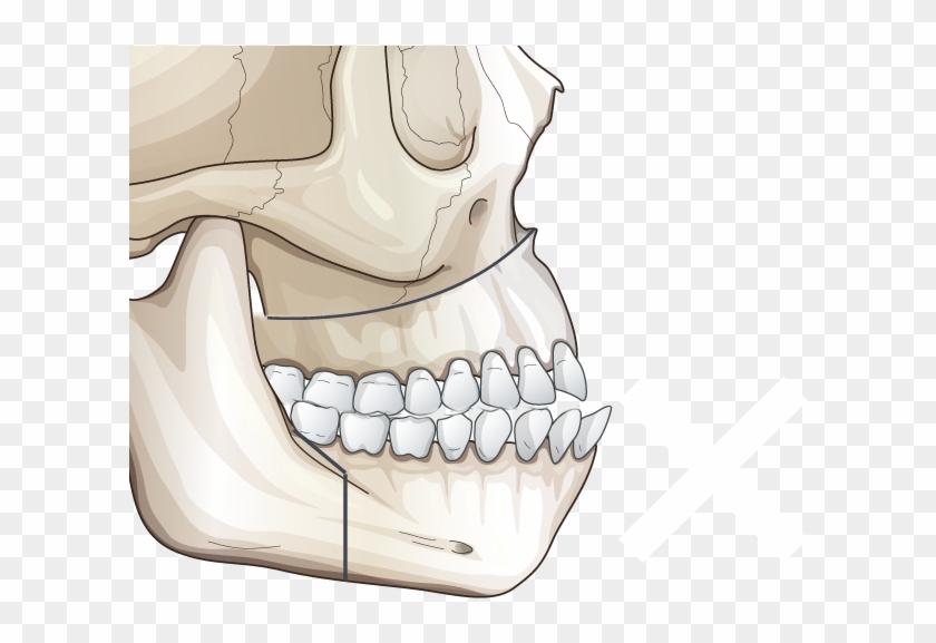Correction With Two-jaw Surgery - X Music Festival 2017 Cardiff Clipart