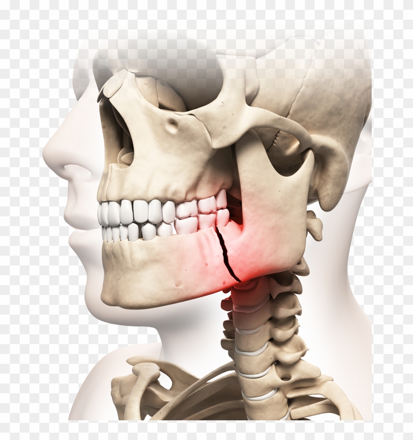 Illustration Of Skull With Broken Jaw Highlighted In - Oral Maxillofacial Surgery Trauma Clipart #4339373