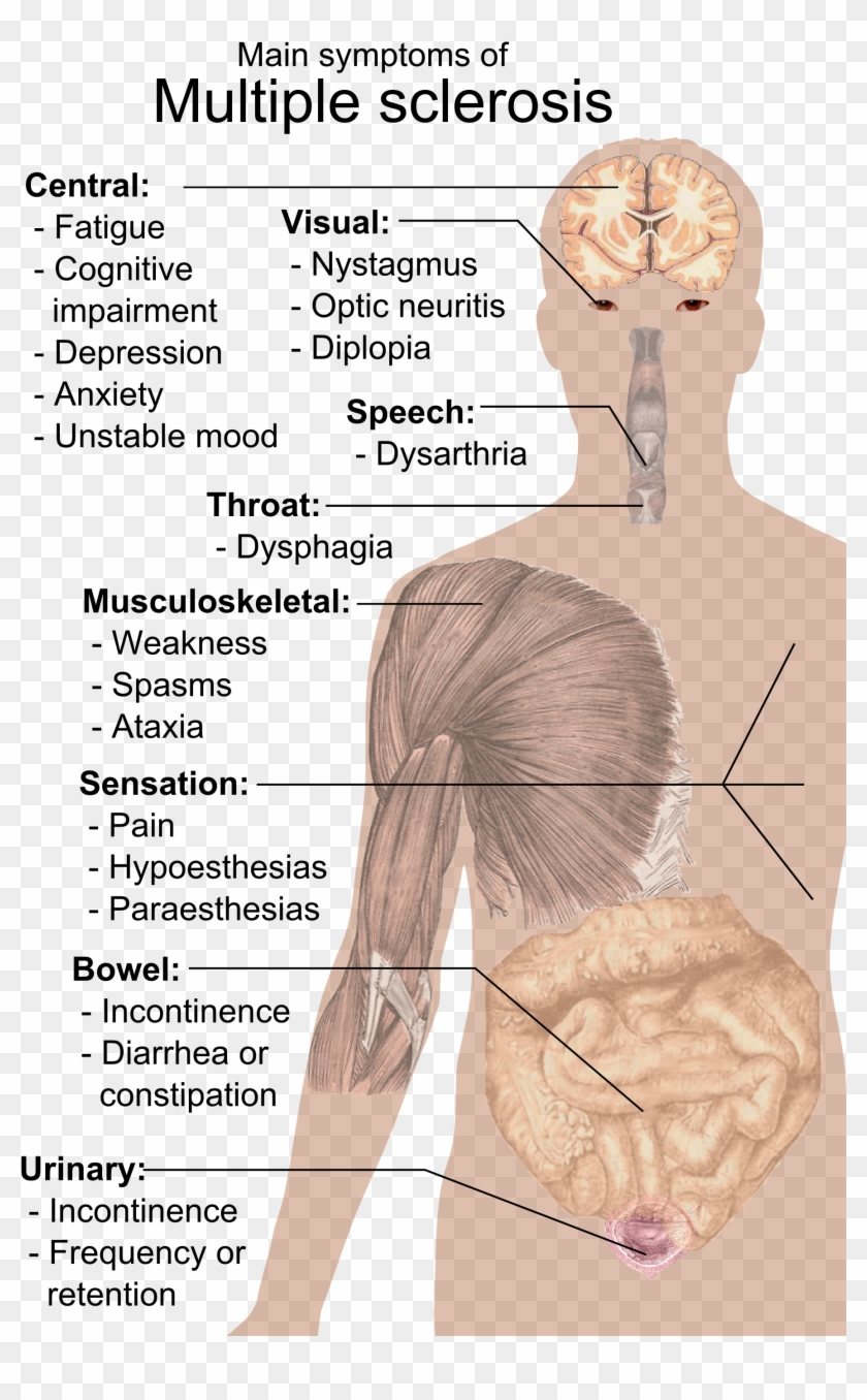 Symptoms Of Multiple Sclerosis - Multiple Sclerosis Body Clipart