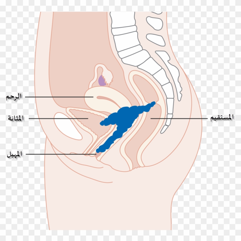 Diagram Showing Stage 4a Cervical Cancer Cruk 236-ar - Illustration Clipart #441927