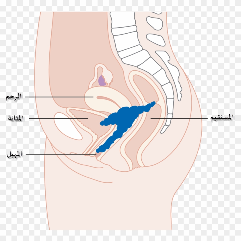Diagram Showing Stage 4a Cervical Cancer Cruk 236-ar - Illustration Clipart