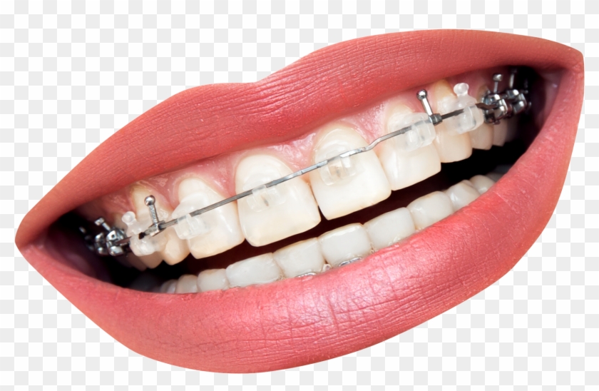 Transparent Mouth With Braces Clipart
