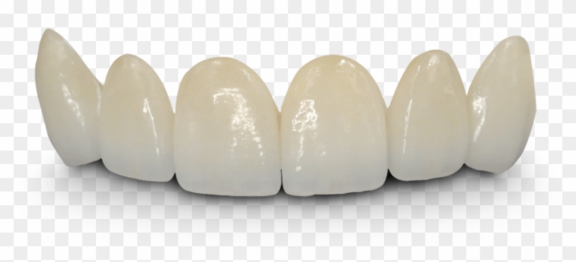 Teeth Png Hd - Crown And Bridge Hd Clipart #445878