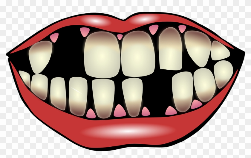 What Leads To Missing Teeth - Missing Teeth Clipart - Png Download