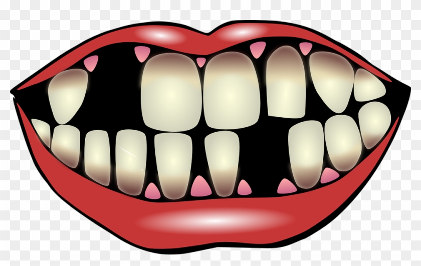 What Leads To Missing Teeth - Missing Teeth Clipart - Png Download #445971