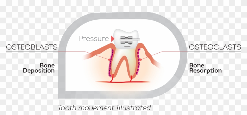 How Teeth Move - Illustration Clipart #446735