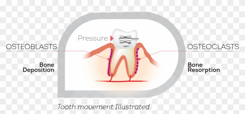 How Teeth Move - Illustration Clipart