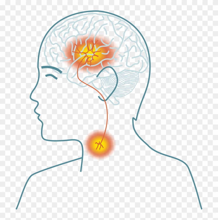 A Disease Of The People - Stroke Disease Transparent Background Clipart