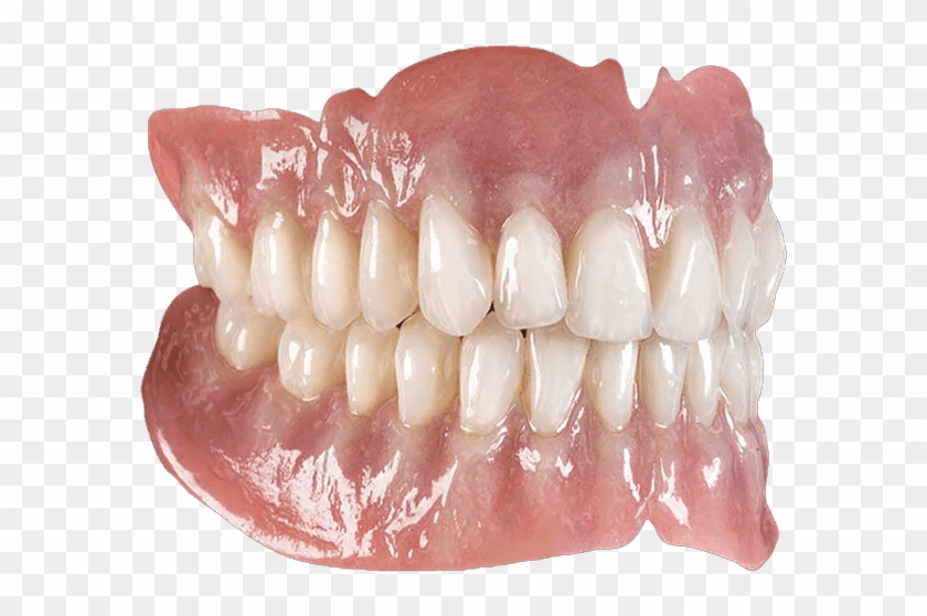 Implant Supported Dentures Are The Best Form Of False - Dental Prosthesis Clipart #4451281