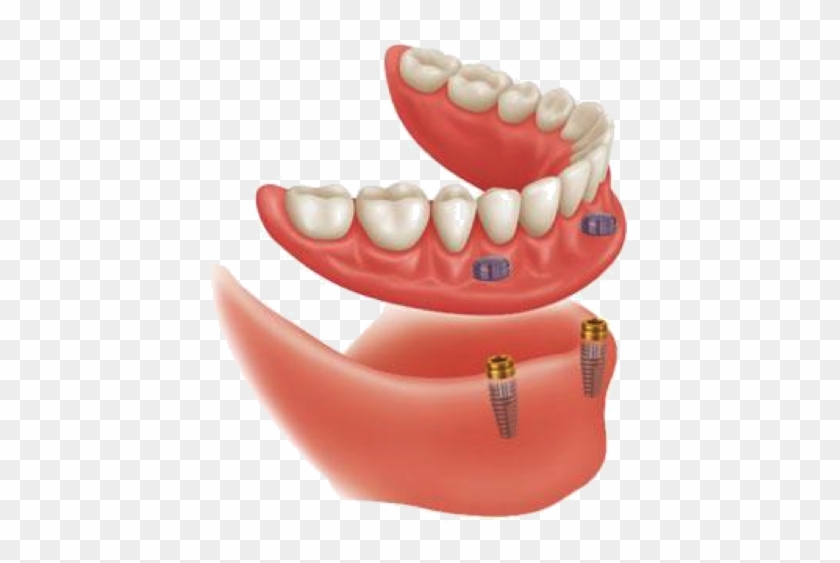 Implant Retained Mandibular Overdentures Clipart #4451515