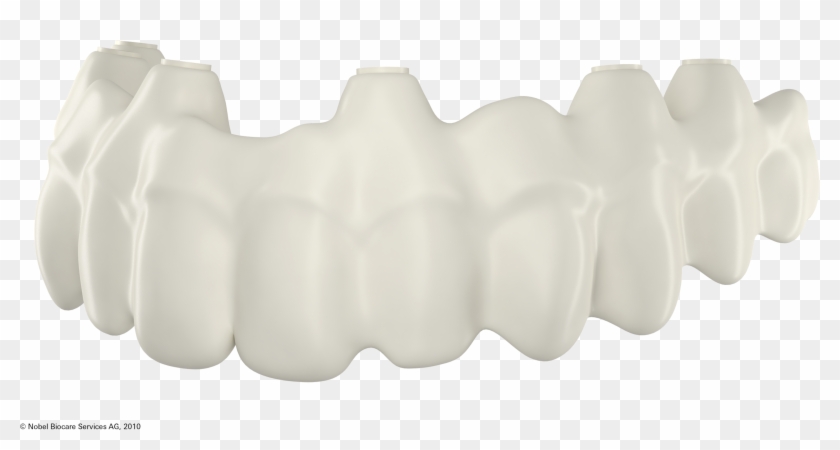 Implant Retained Denture - Bone Clipart #4451977