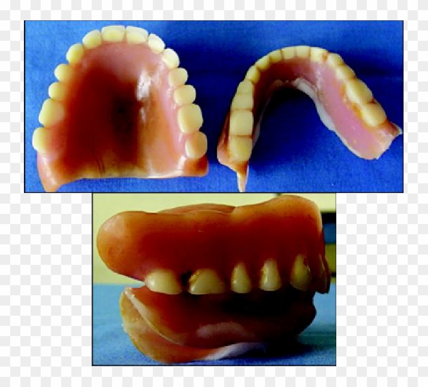 Existing Dentures Of The Patient - Denture Teeth Wear Clipart #4452186