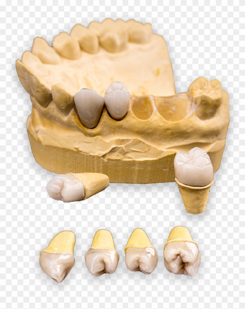 When Your Gums Are Restored To A Healthy Condition - Sculpture Clipart #4452293