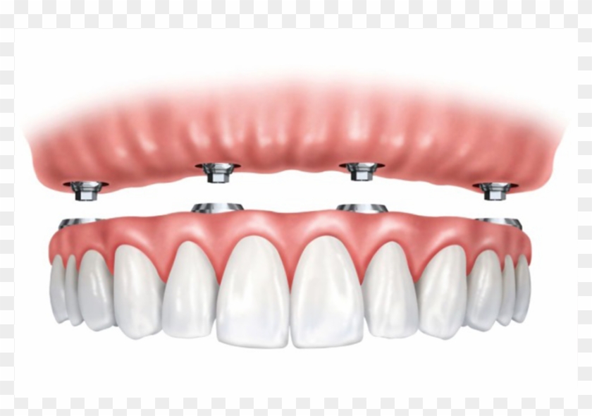 Implant Supported Overdentures - Implant Replacement All Teeth Clipart #4453046