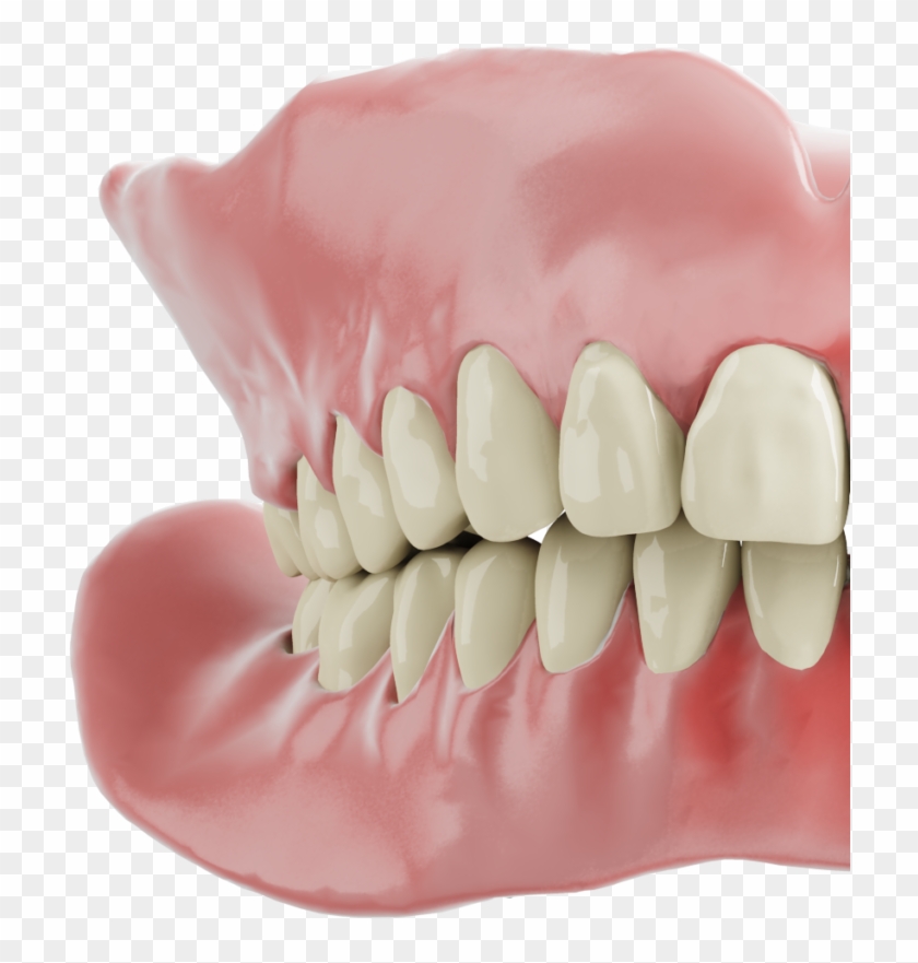 Front Denture - Dentures Clipart #4453077
