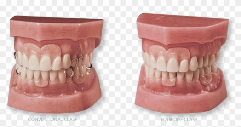 Equipoise Vs Conv In Text - Composite Material Clipart