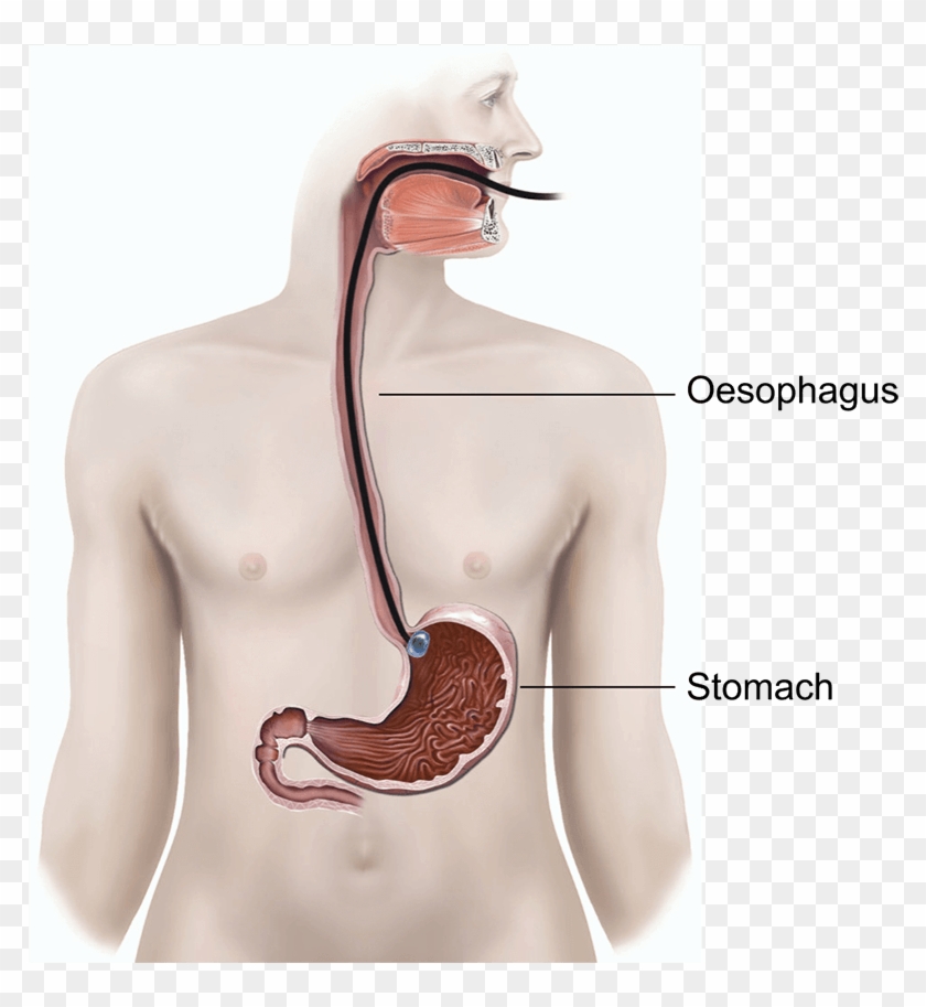 Illustration Showing An Endoscopic Ultrasound - Upper Gi Clipart