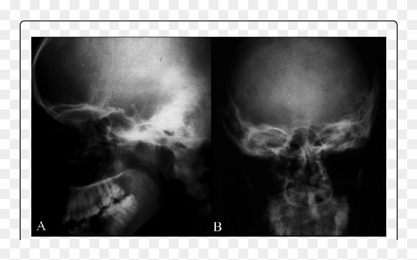 Lateral And Forward (b) Radiographs Post-surgical - Radiology Clipart