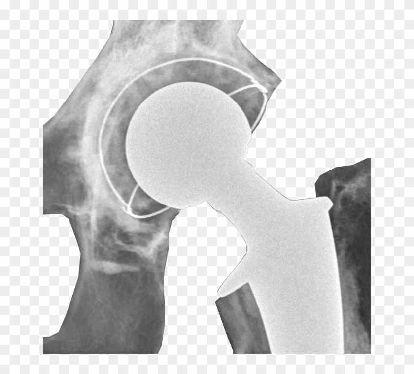 Postoperative Radiograph Of Hip Prosthesis - Hip Replacement Clipart #4523597