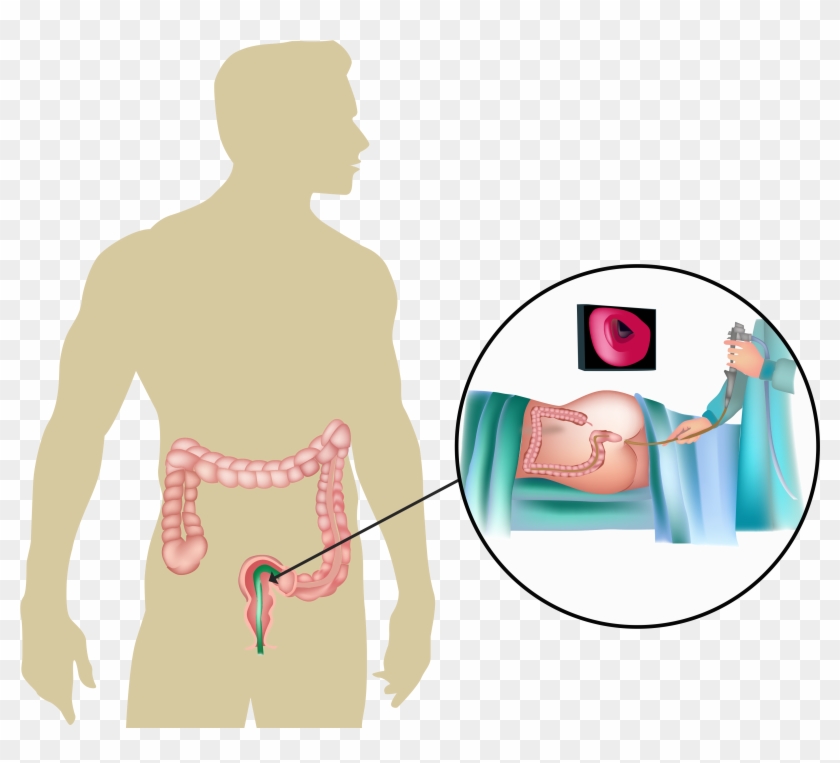 A Flexible Sigmoidoscopy Is A Procedure That Examines - Colon Disease Png Clipart #4527330