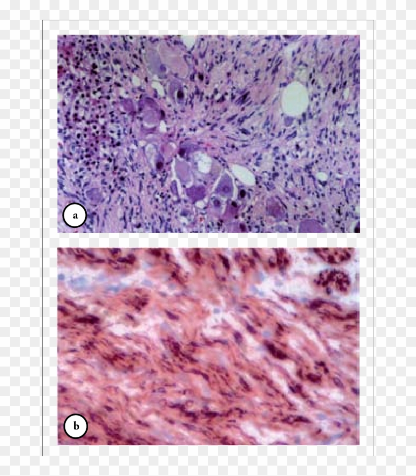 Microscopic Findings Showing A) Scattered Mature Ganglionic - Granite Clipart #4603068