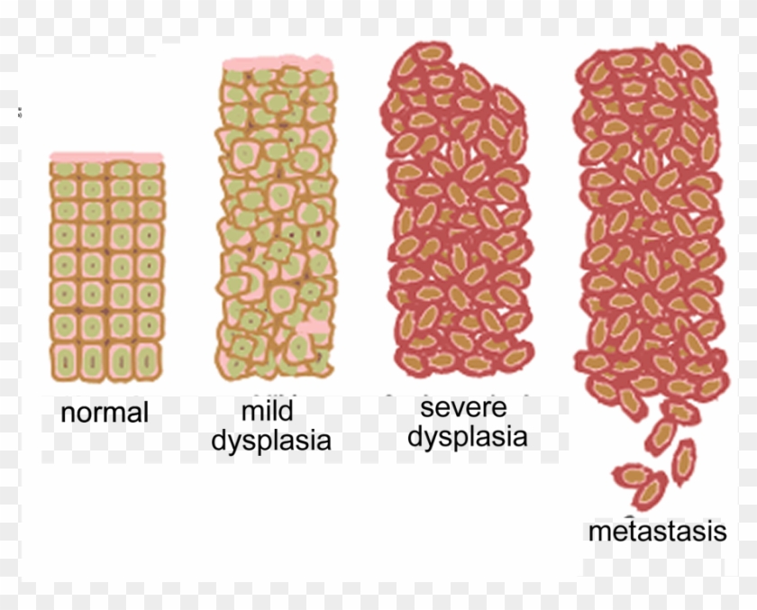 Progressive Increases In Cell Division And Abnormal - Hypertrophy Hyperplasia Metaplasia And Dysplasia Clipart