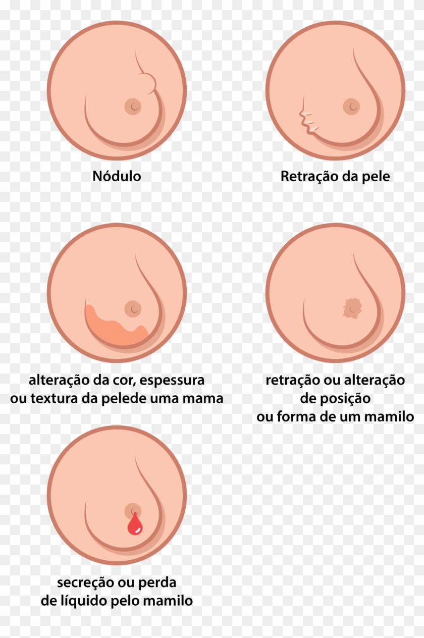 Sinais Iniciais Que Indicam A Possibilidade De Um Cancro - Fazer O Autoexame Da Mama Clipart