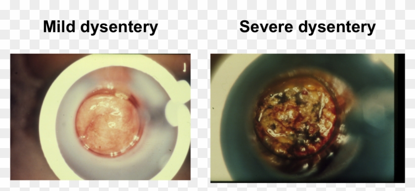 Human Feces, Dysentery, Diarrhea, Jaw, Ear Png Image - Dysentery Feces Clipart #4624816