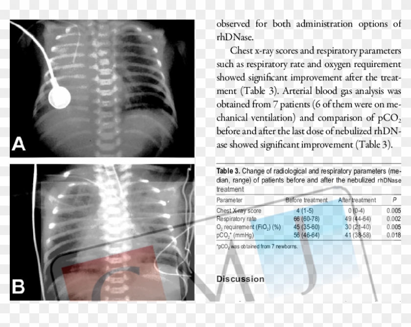Localization Of Percutaneous Central Venous Catheter - Medical Imaging Clipart