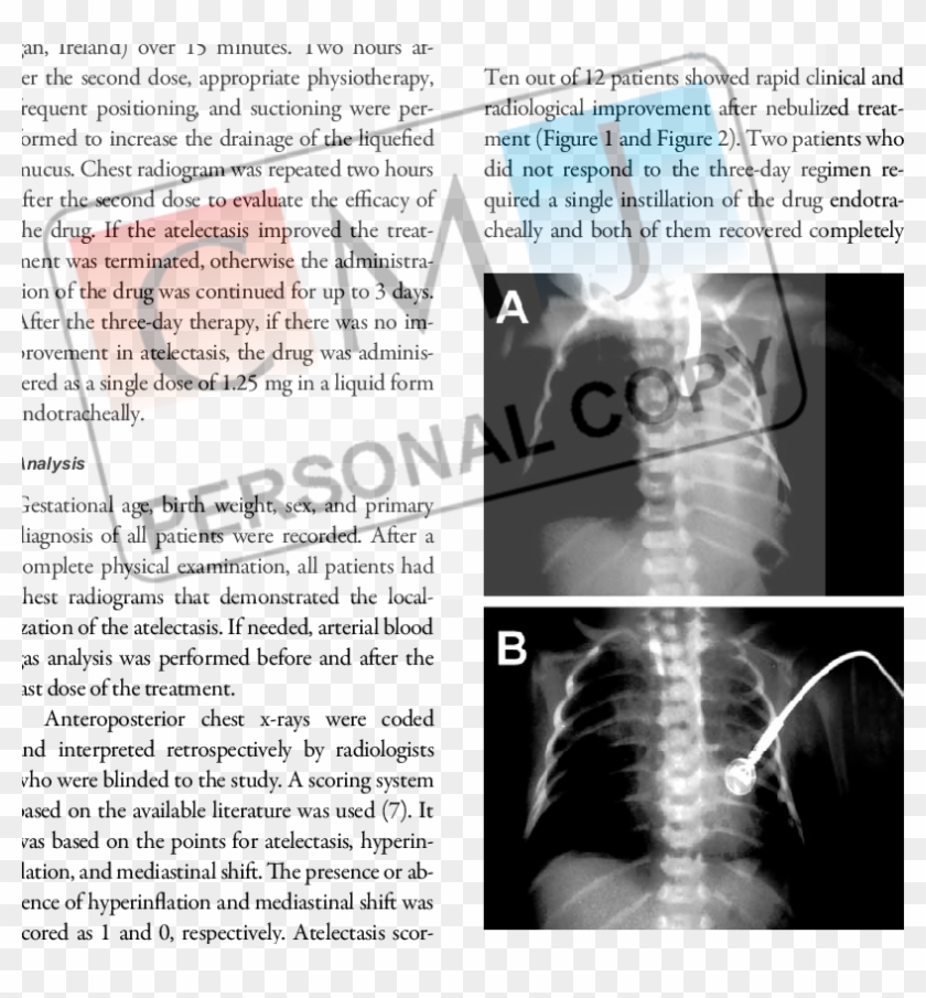 Rhdnase Treatment Resolved Almost Complete Atelectasis - Stranger By Chris Van Allsburg Clipart #4661621