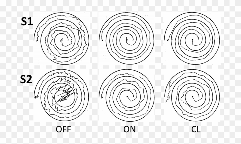 Essential Tremor Vs Parkinson Spiral Clipart