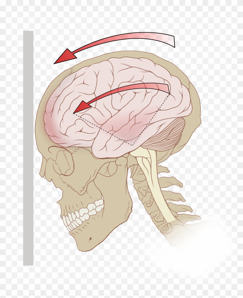 Concussion Injury Clipart