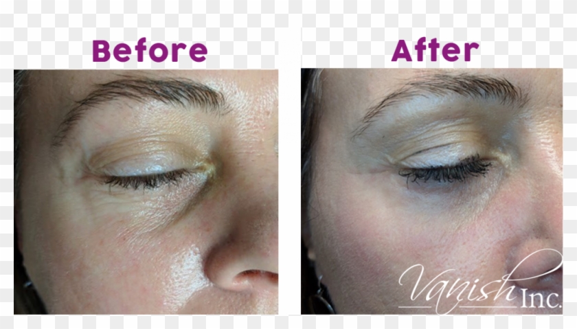 Undereye Wrinkles Plasma Pen - Eye Shadow Clipart