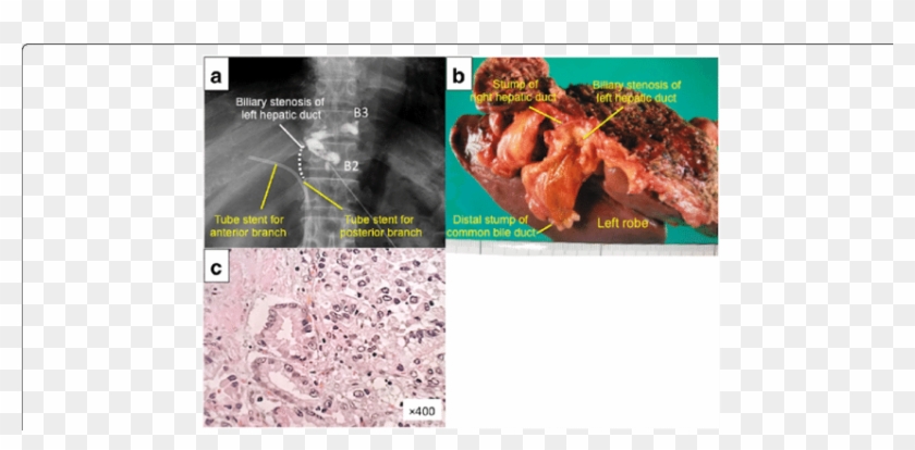Initial Resection Of Primary Tumor - Venison Clipart #4745924
