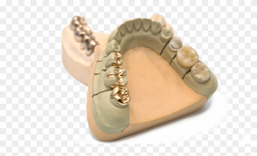 Gold Inlays - Incrustaciones En Oro Dentales Clipart #4757070