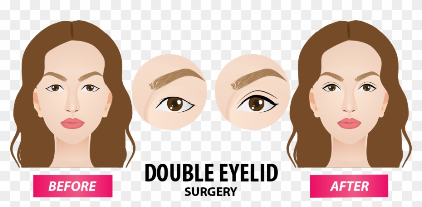 Types Of Double Eyelid Surgery - Girl Clipart