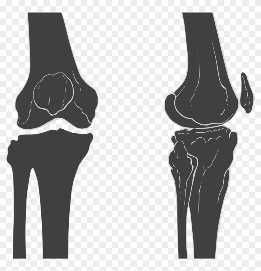 Bone Densitometry Scan - Knee Skeleton Clipart