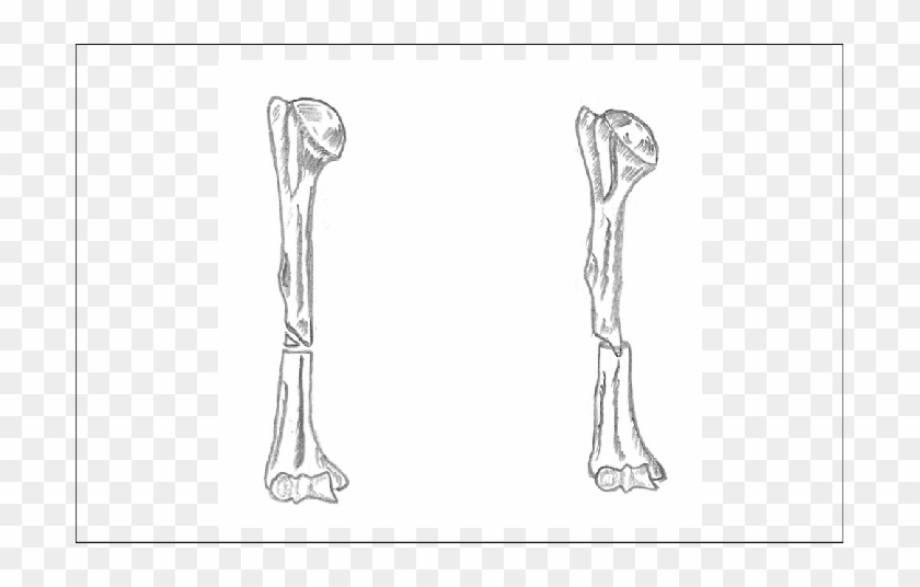 The Invaginating Fragment Of 1 Cm Is Sculpted And Fitted - Sketch Clipart