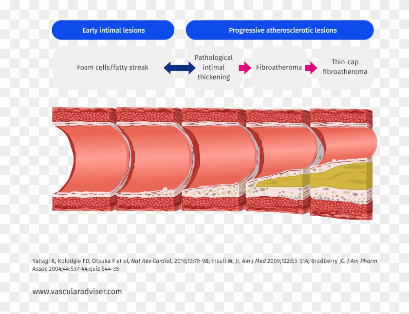 Atherosclerotic Lesion Development - Atherosclerotic Lesions Clipart #4884013