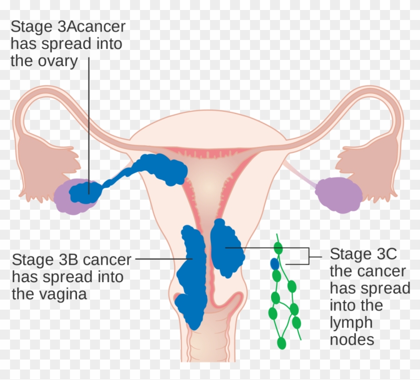 In Stage Iii, The Cancer Has Spread To The Lower Third - 子宮 內 膜 癌 放療 Clipart